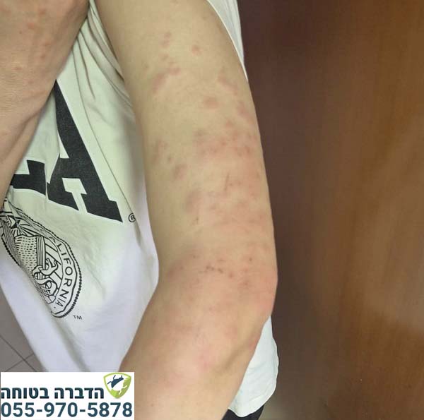 עקיצות פשפשי מיטה ביד
